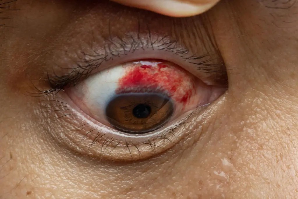 sangue nos olhos, também conhecido como hiposfagma