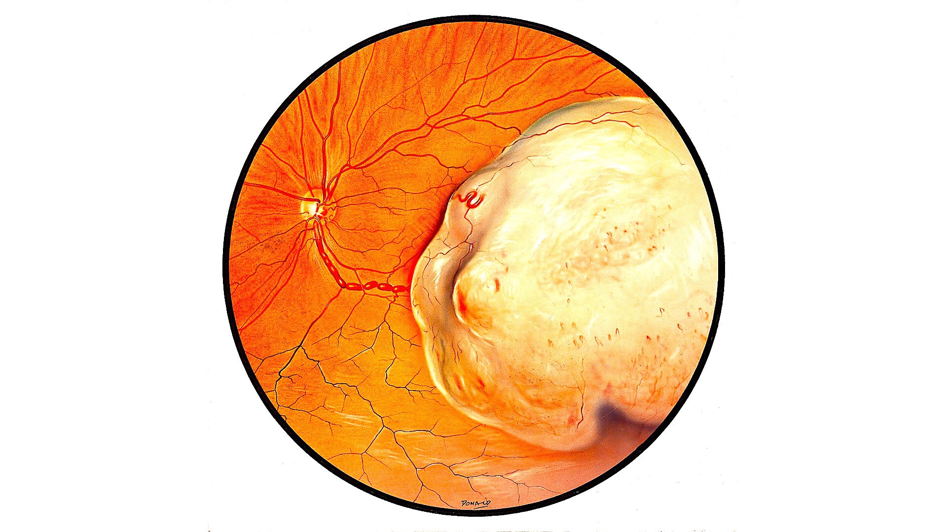 imagem de melanoma intraocular