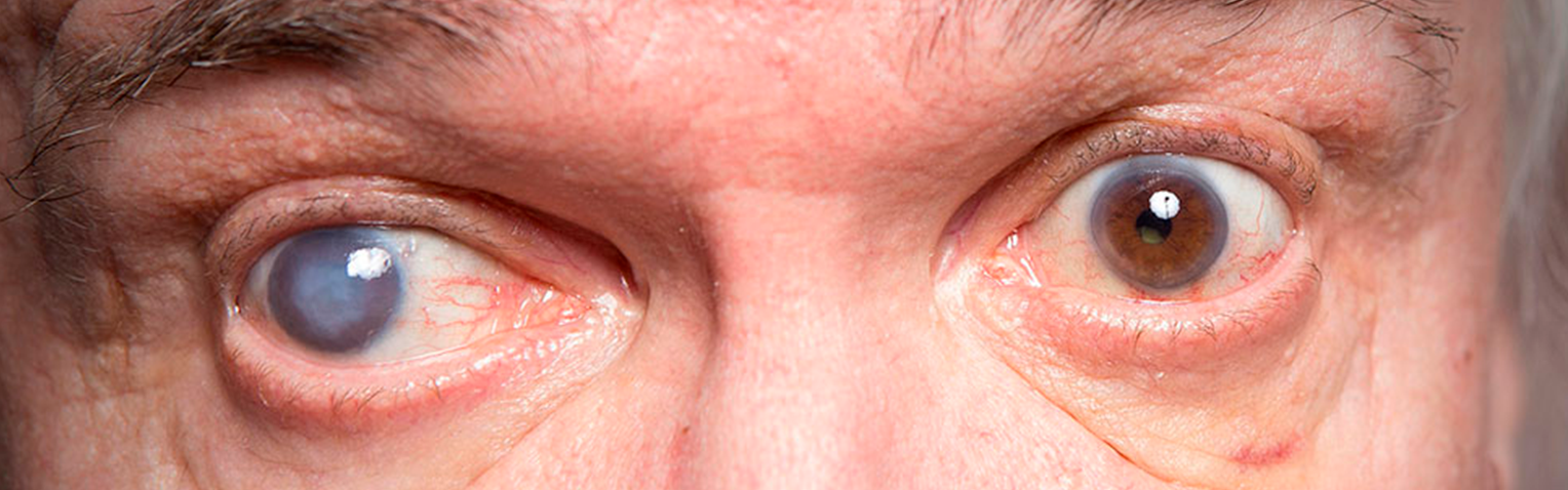 olhos com glaucoma