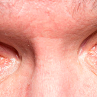 olhos com glaucoma