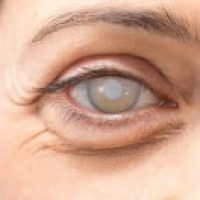cataract-surgery-complications-1200x630_thumb