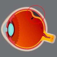 descolamento-de-retina