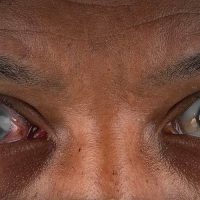 uma mulher com olhos com glaucoma