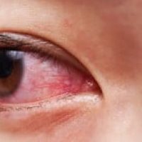 infeccao-ocular-olhos-0519-1400x800_thumb