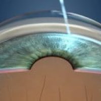 laser-para-o-tratamento-de-glaucoma_thumb
