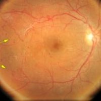 retinopatia-diabetica_med_thumb